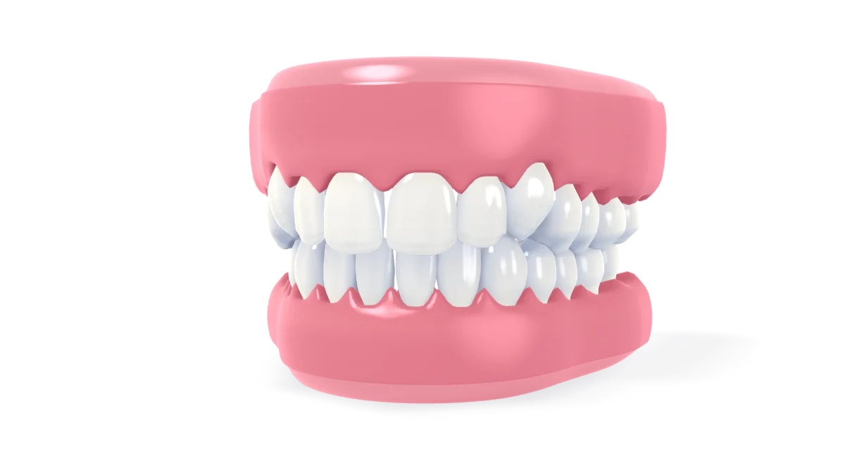 Full acrylic dentures: on toothless gums the upper denture settles onto its ridge, the lower one drops into place, and the bite closes on a new set of teeth