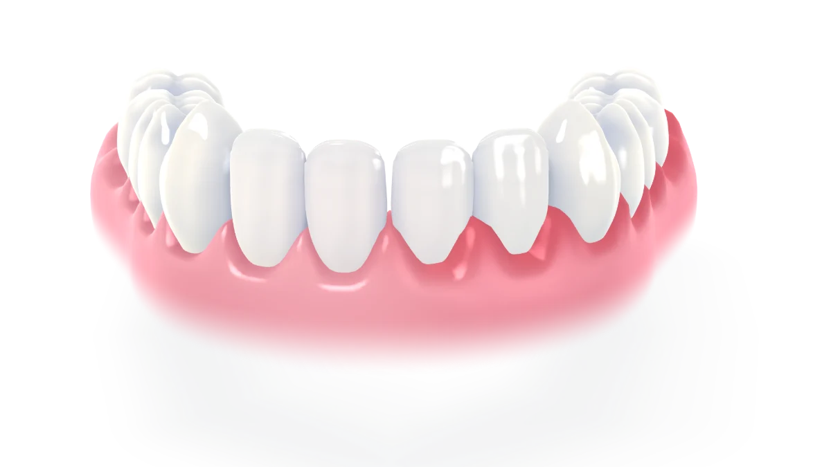 Gum treatment: red, swollen gums are cleaned along the gum line and calm to a firm, healthy pink