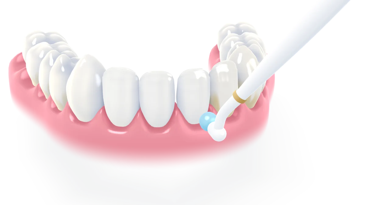A hygiene session: plaque and stain along the gum line are polished away tooth by tooth, leaving clean, bright teeth and calm gums