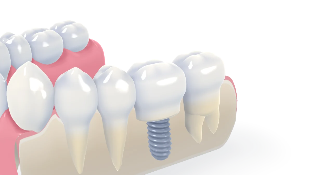How a dental implant is placed