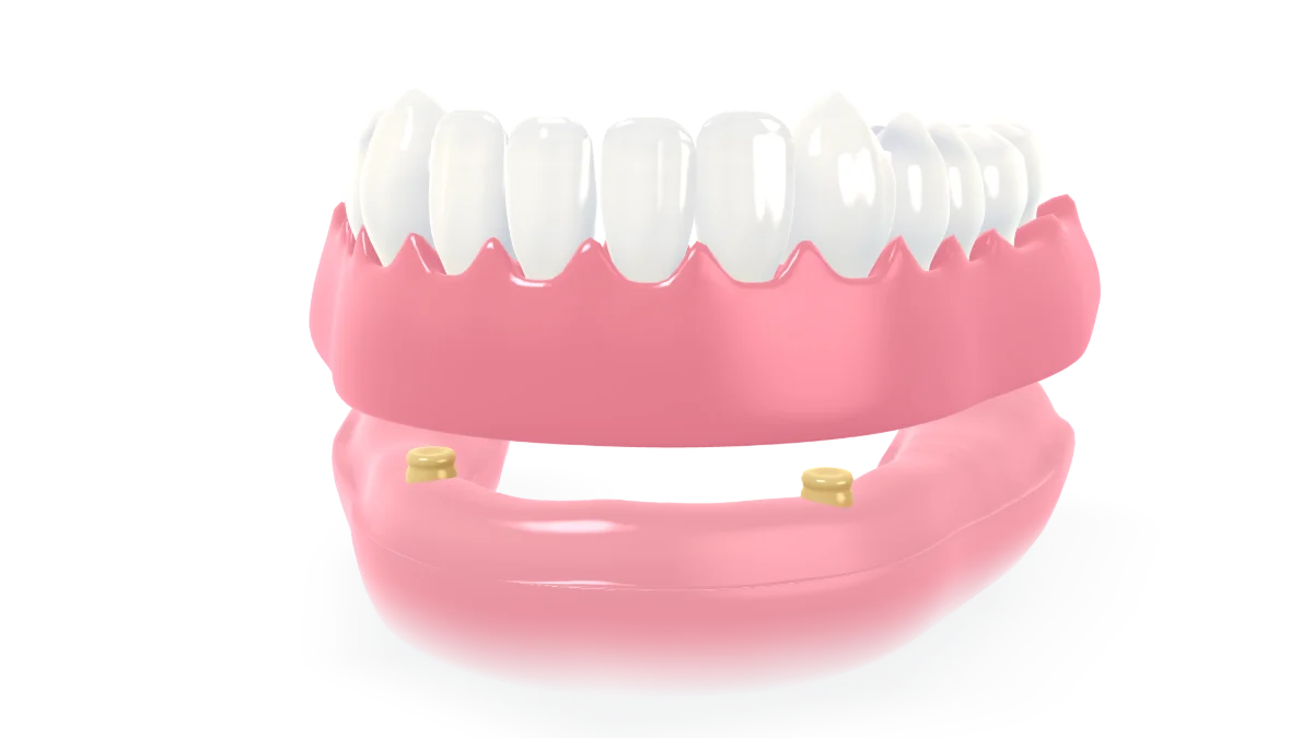 An implant-retained denture: implants go into a toothless lower jaw, attachments go on them, and a full denture clicks firmly into place - and unclips again to be taken out