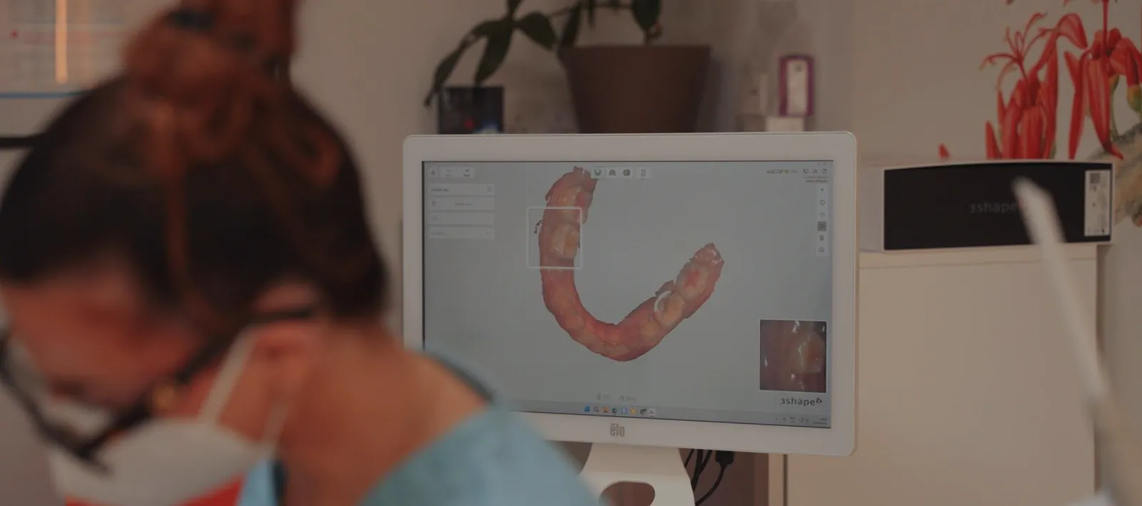 A digital scan of the teeth on screen during a check-up at Apex Dental